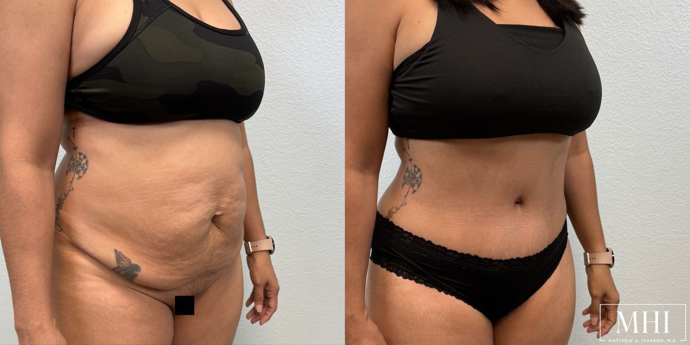 Tummy Tuck - Thumbnail 4