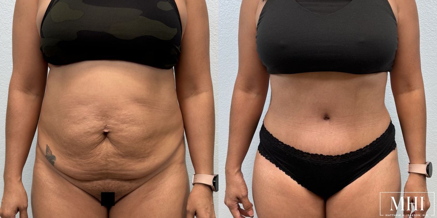 Tummy Tuck - Case 12402