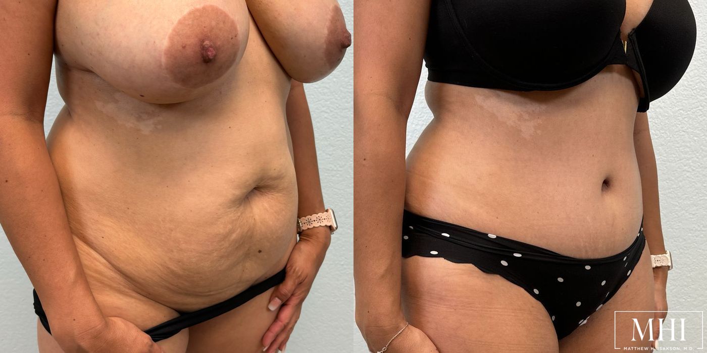 Tummy Tuck - Thumbnail 4