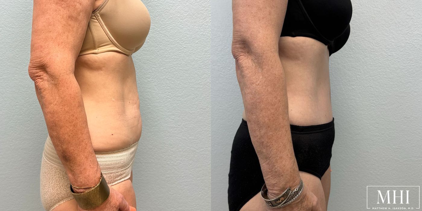 Tummy Tuck - Thumbnail 5