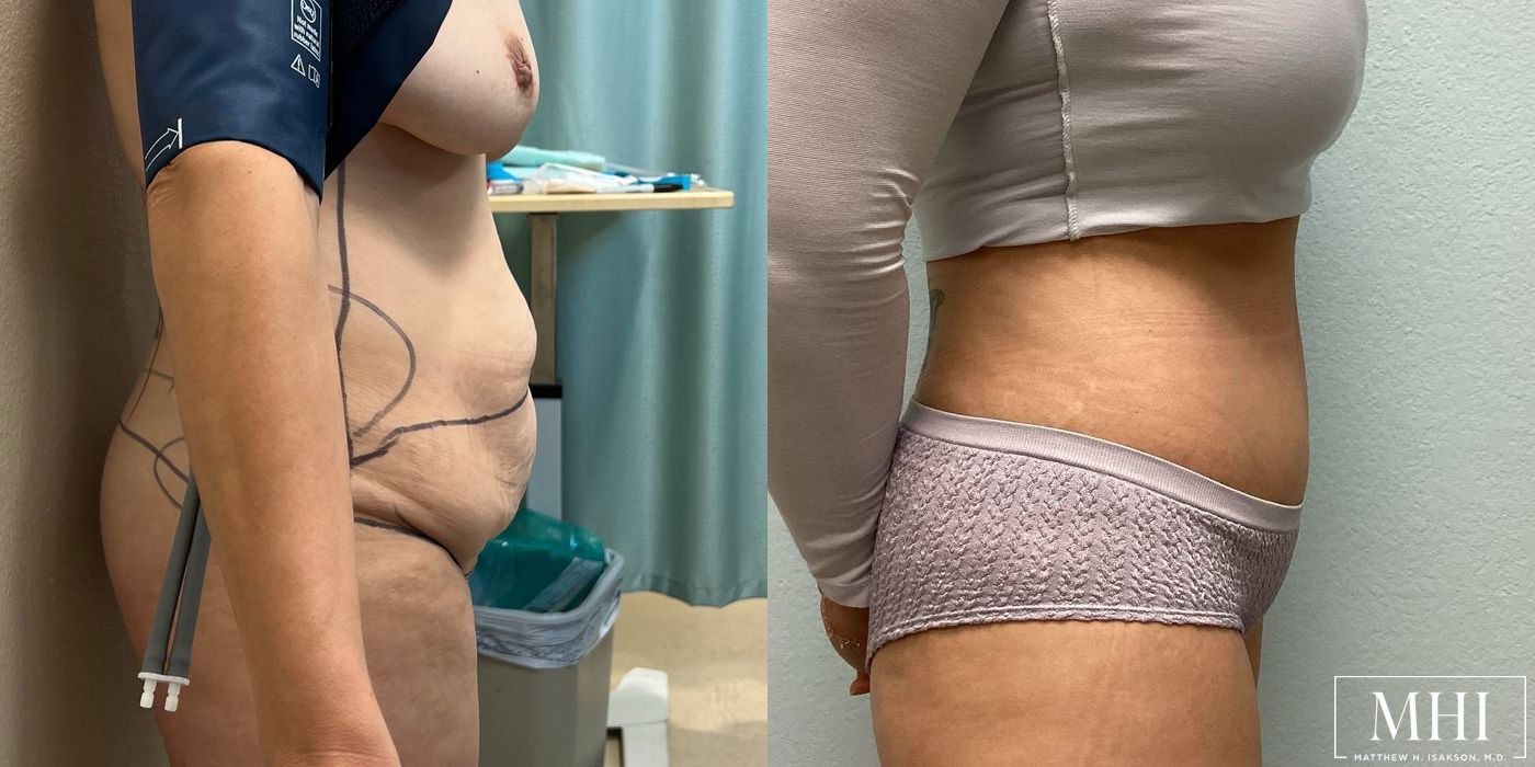 Tummy Tuck - Thumbnail 5