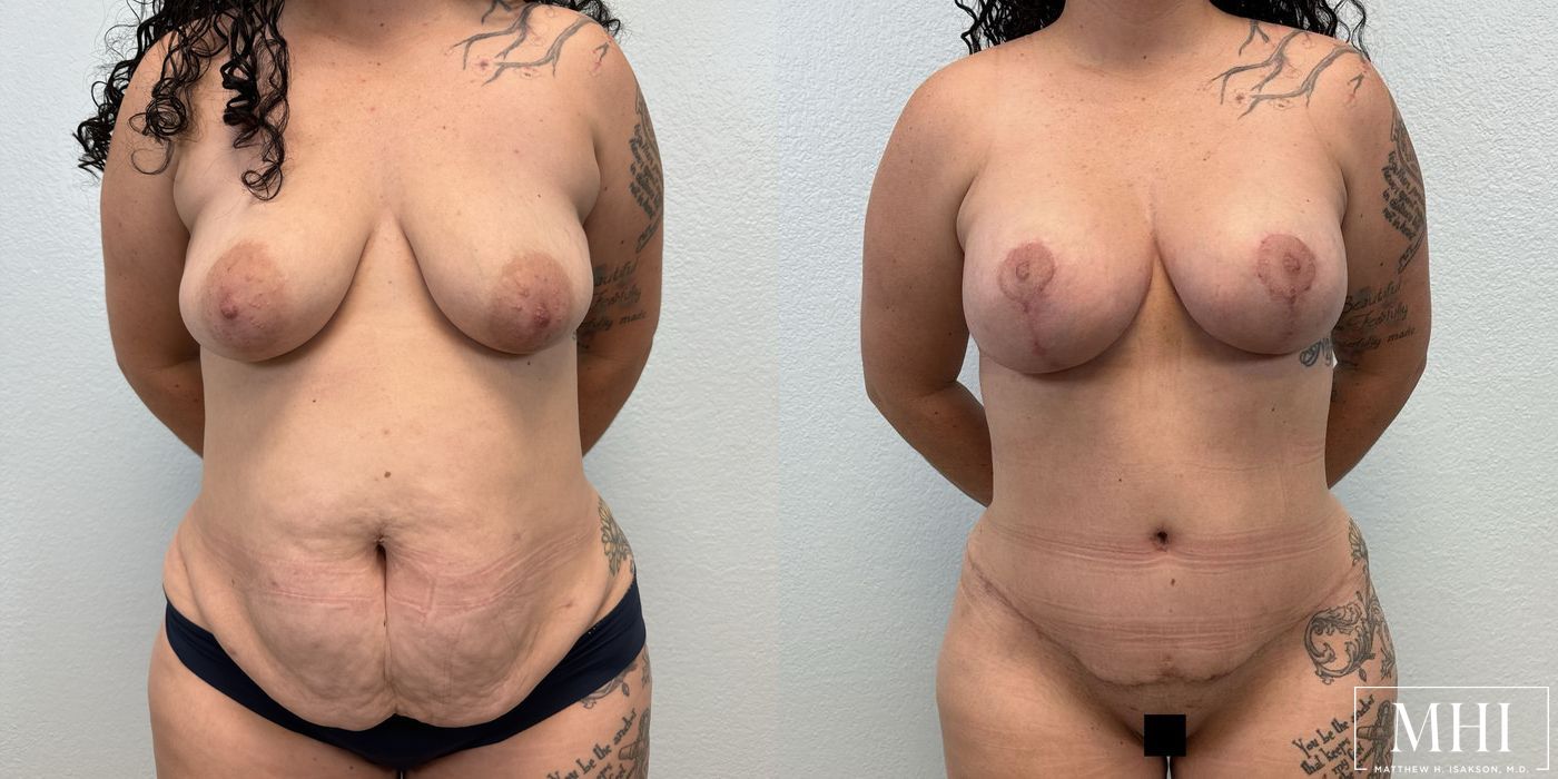 Breast Lift - Case 12152