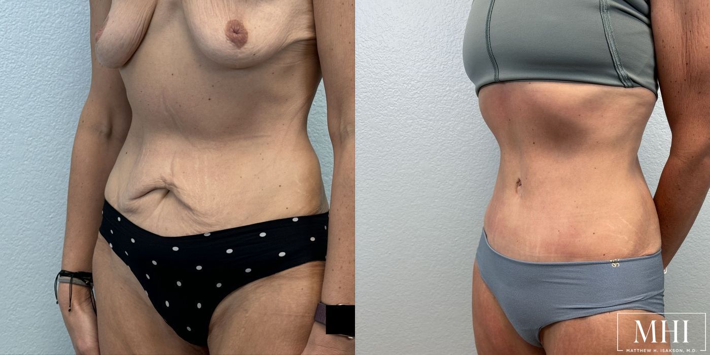 Tummy Tuck - Thumbnail 2