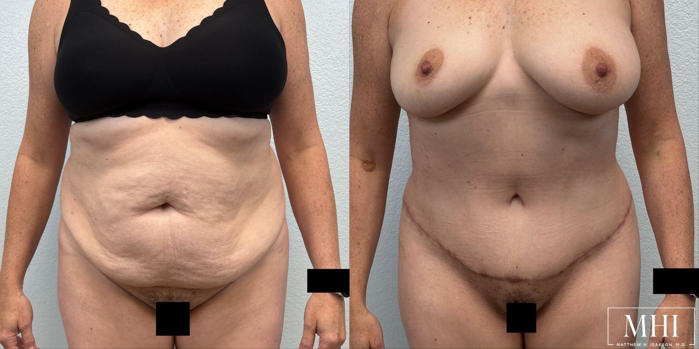 Tummy Tuck - Case 12408