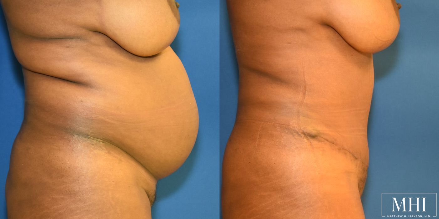 Tummy Tuck - Case 12106