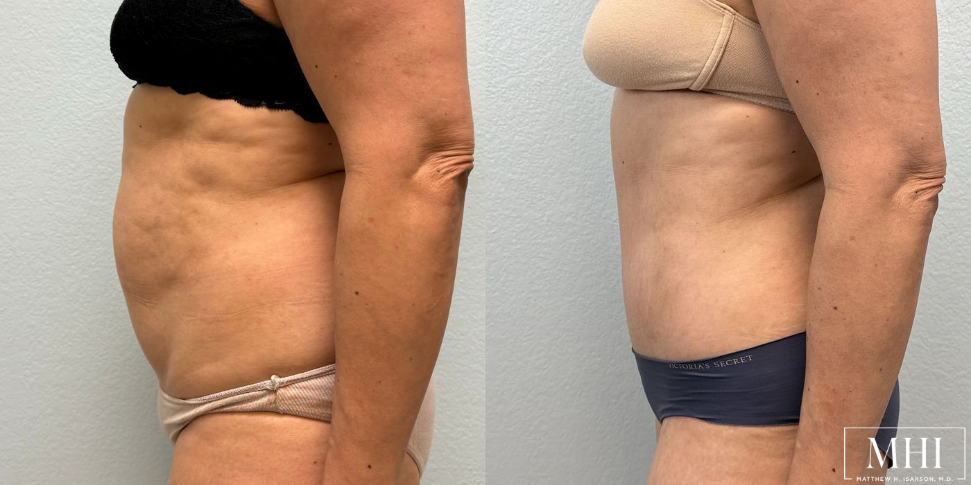 Tummy Tuck - Thumbnail 2