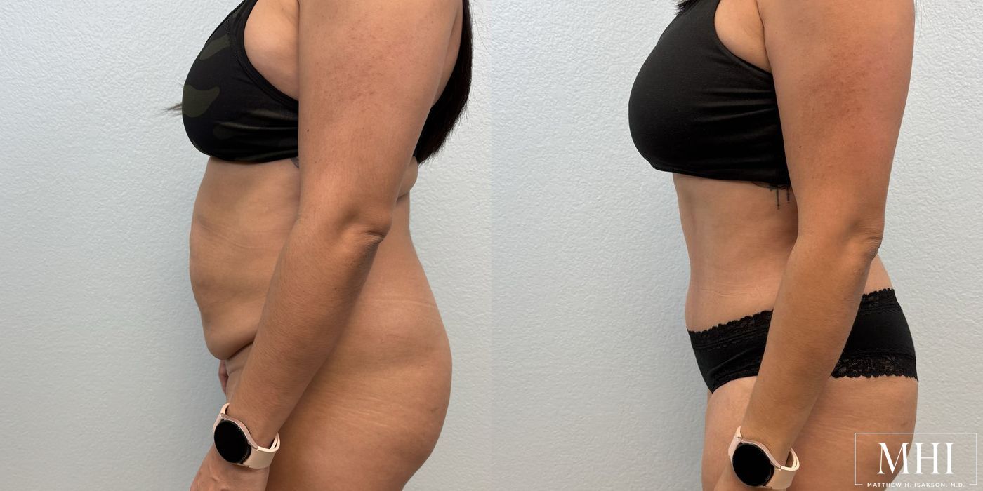 Tummy Tuck - Thumbnail 3