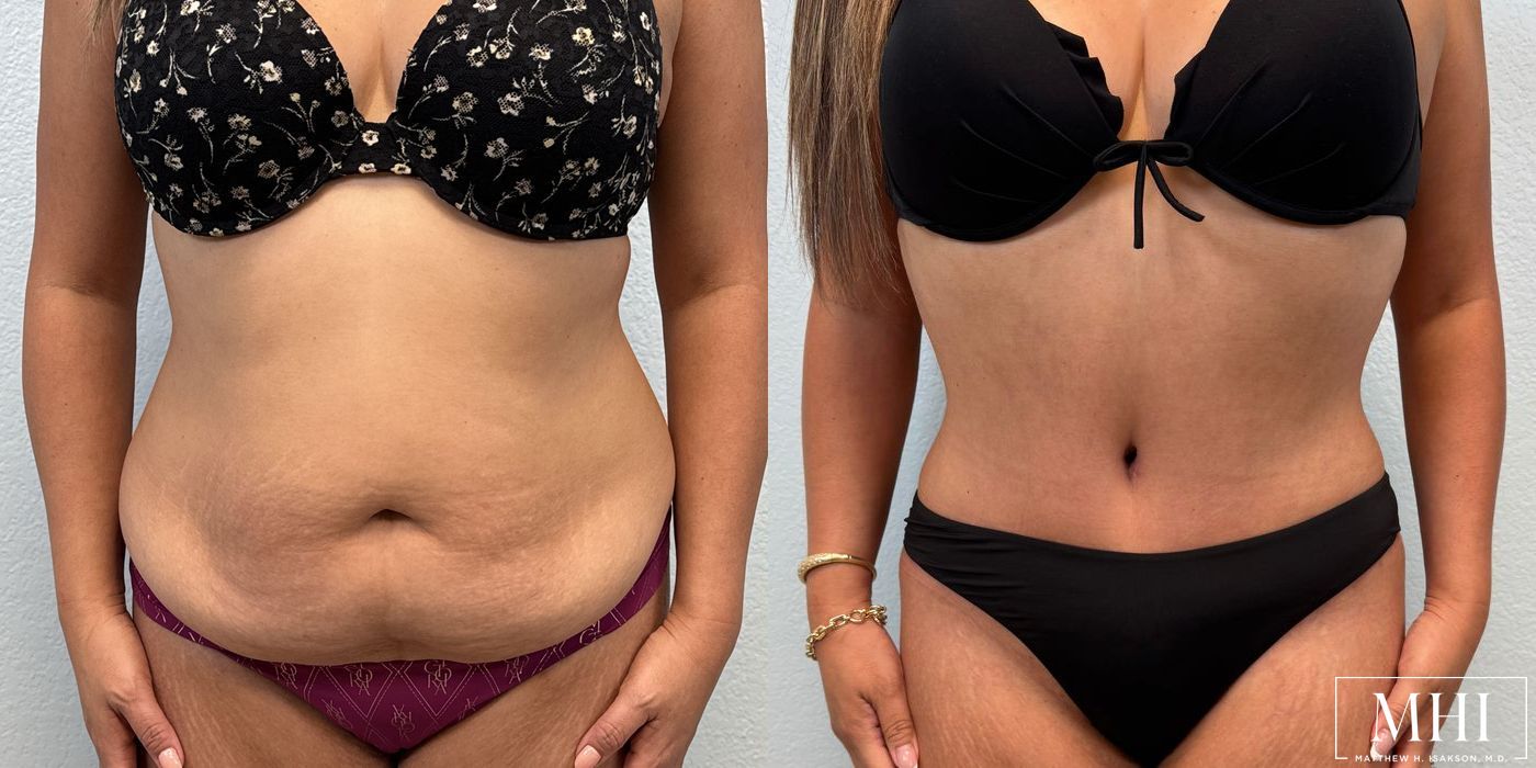 Tummy Tuck - Case 12400