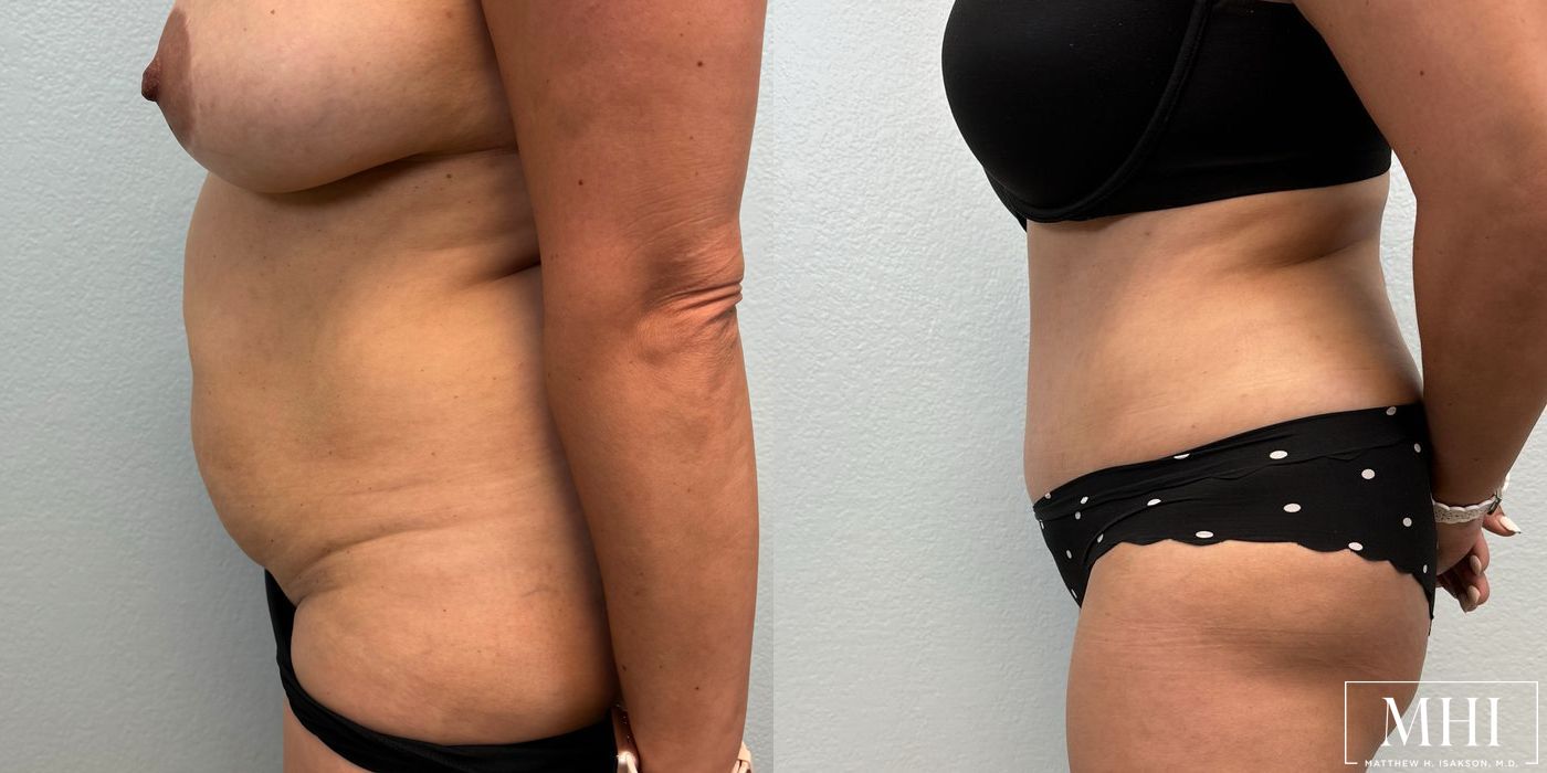 Tummy Tuck - Thumbnail 3