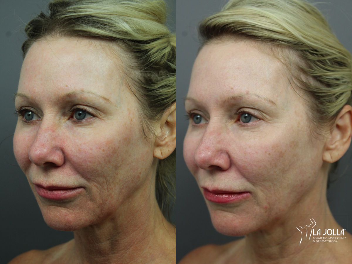 Before and after 6D Platinum Laser Lift case 36397 - Angle 2