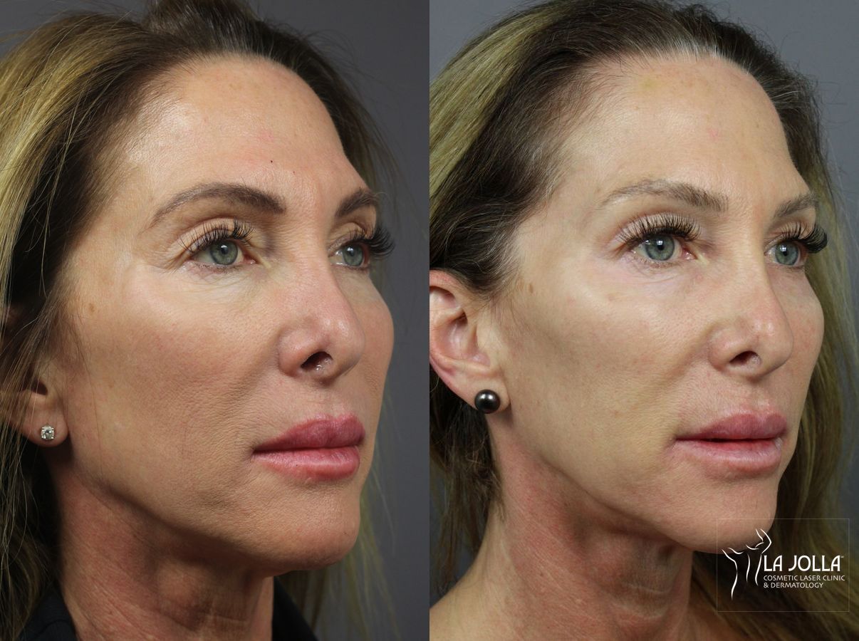 6D Platinum Laser Lift of Eyes and Cheeks Before and After