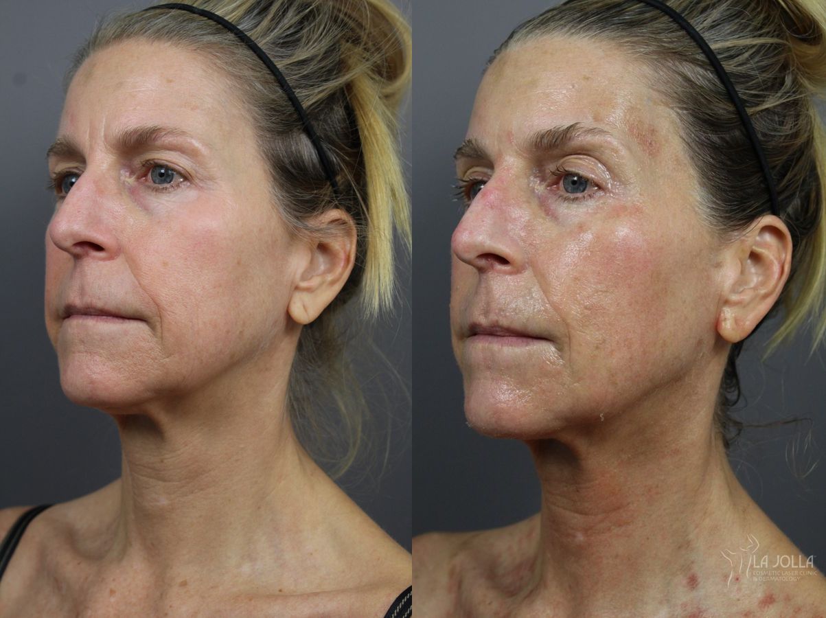 Before and after 6D Platinum Laser Lift case 36400 - Angle 3