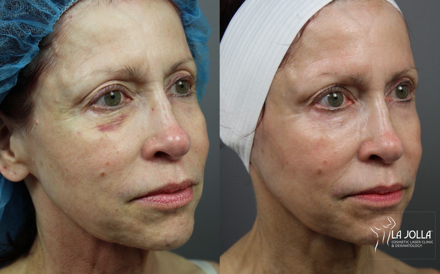 Before and after 6D Platinum Laser Lift case 36441 - Angle 2