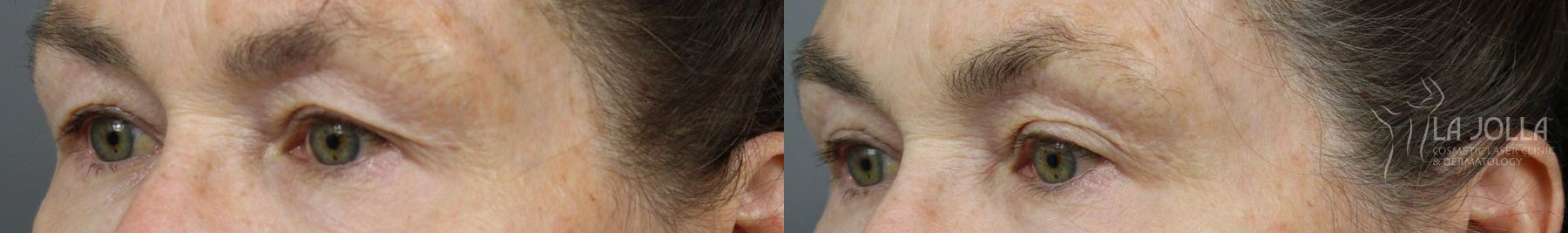 Before and after 6D Platinum Laser Lift case 36438