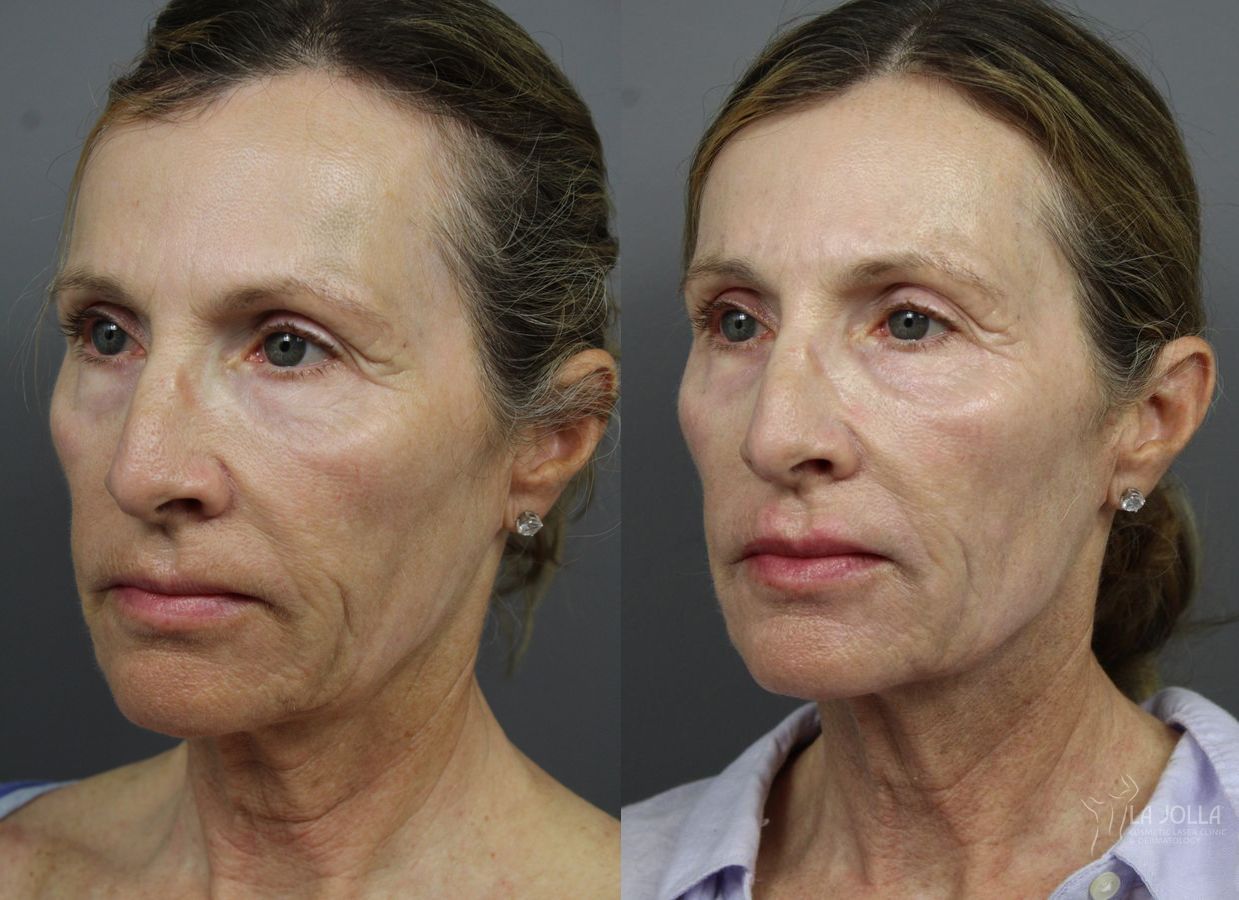 Before and after 6D Platinum Laser Lift case 36387