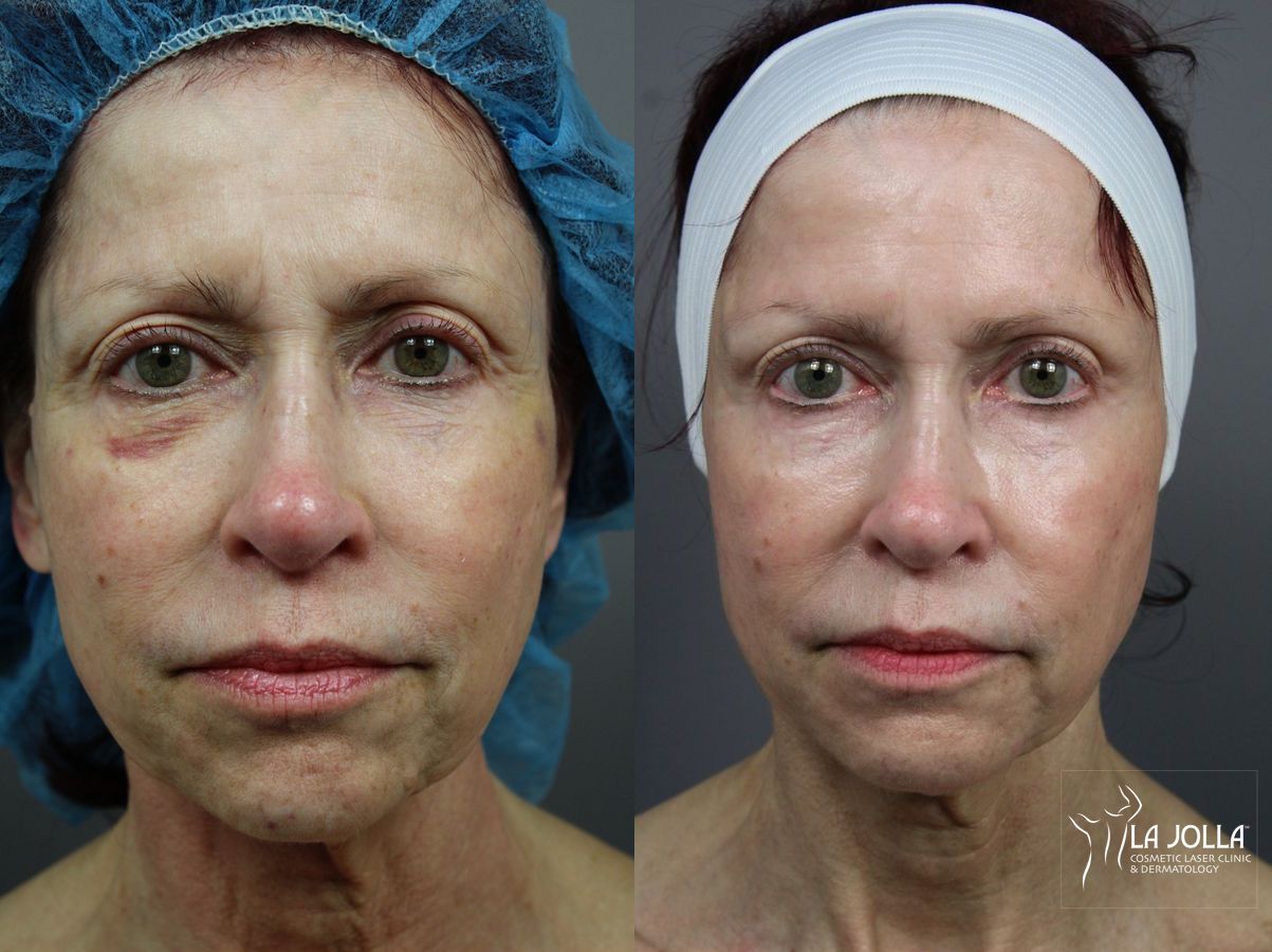 Before and after 6D Platinum Laser Lift case 36441