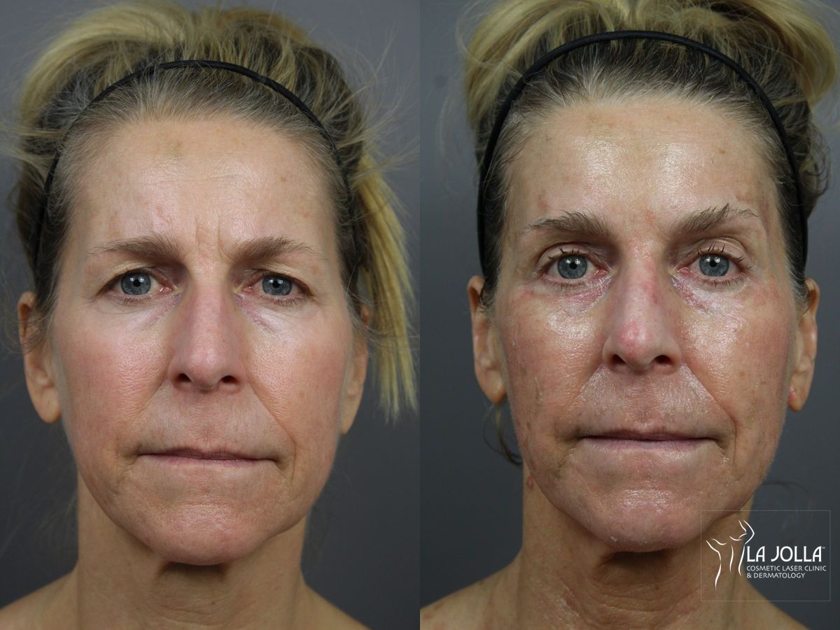 Before and after 6D Platinum Laser Lift case 36400