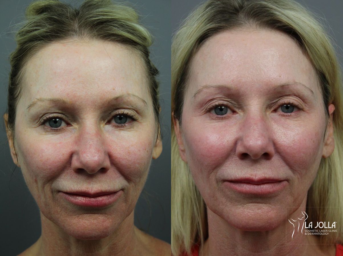 Before and after 6D Platinum Laser Lift case 36397
