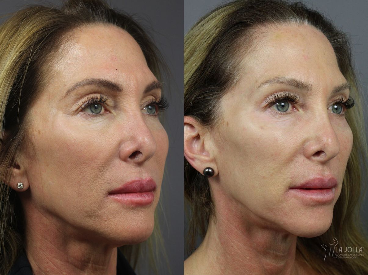 6D Platinum Laser Lift of Eyes and Cheeks Before and After