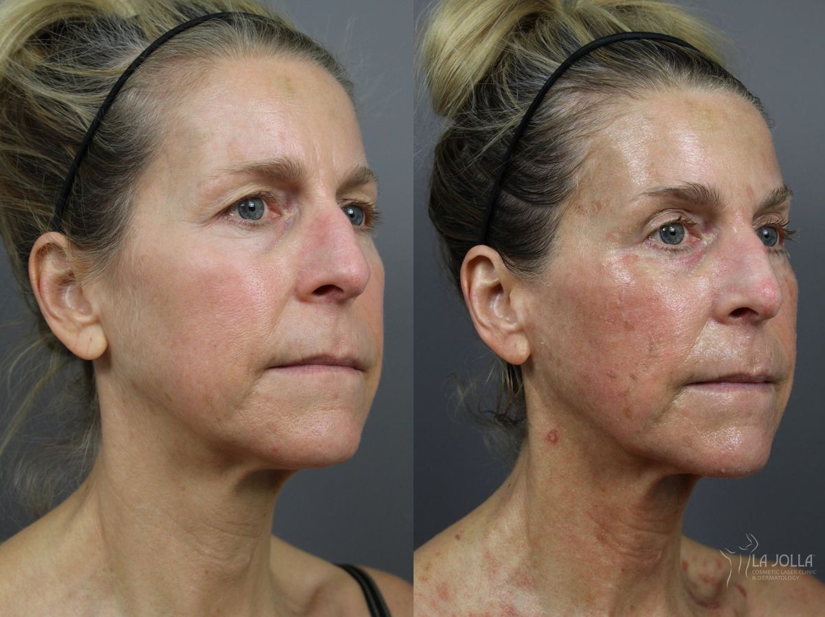 Before and after 6D Platinum Laser Lift case 36400 - Angle 2