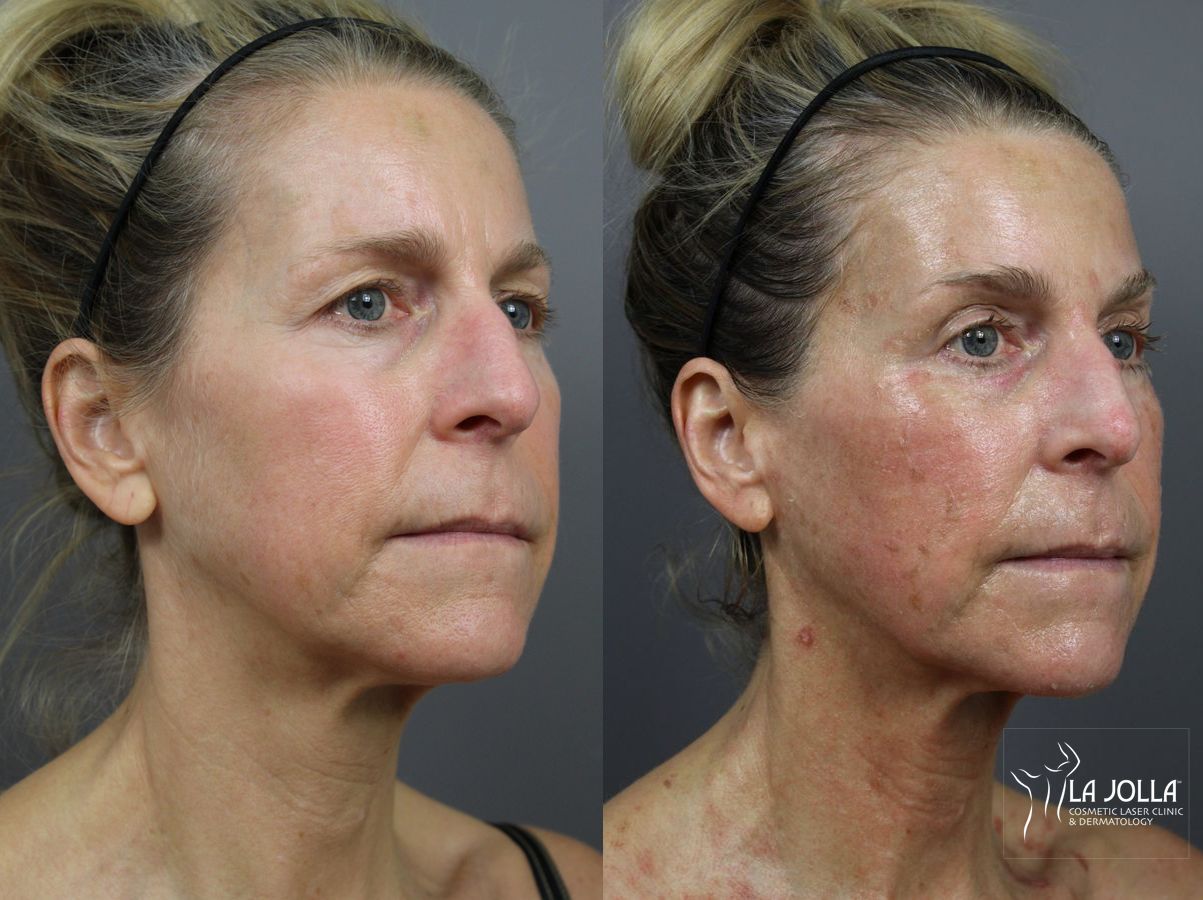 Before and after 6D Platinum Laser Lift case 36400 - Angle 2