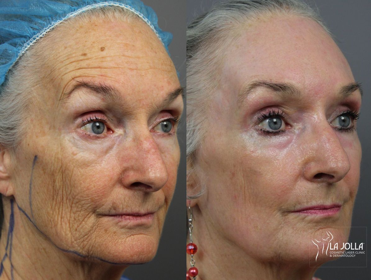 Before and after Ablative Laser Treatment case 36324 - Angle 4