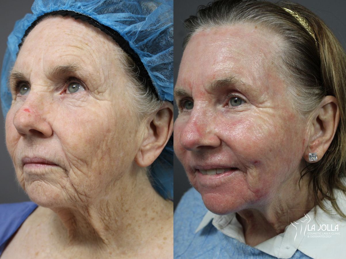 Before and after Ablative Laser Treatment case 36143 - Angle 3