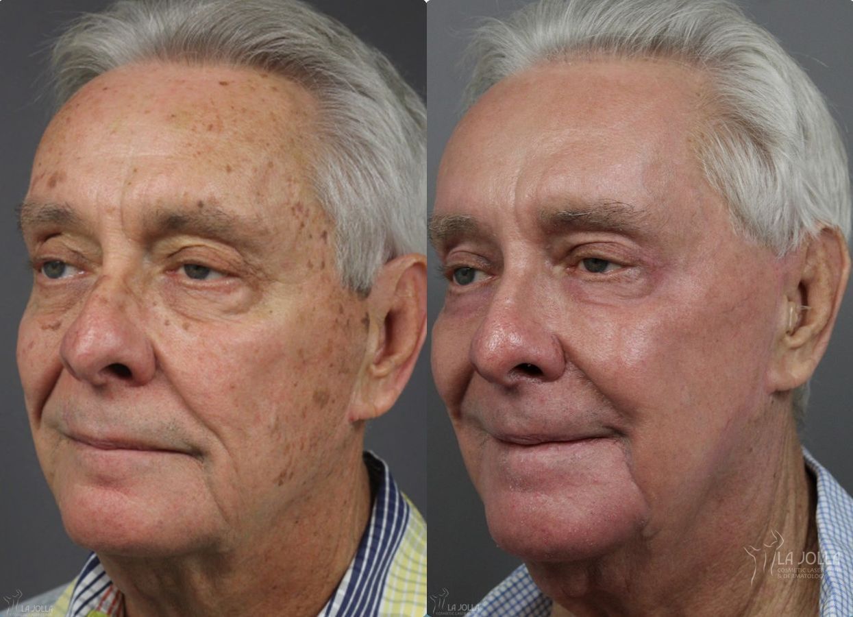 Before and after Ablative Laser Treatment case 36279 - Angle 3