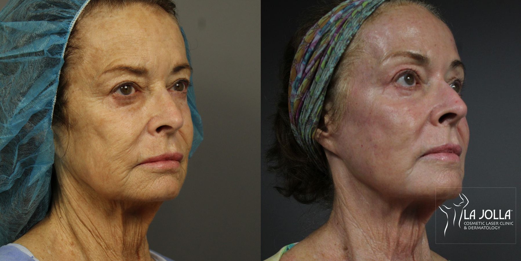 Before and after Ablative Laser Treatment case 36223 - Angle 2