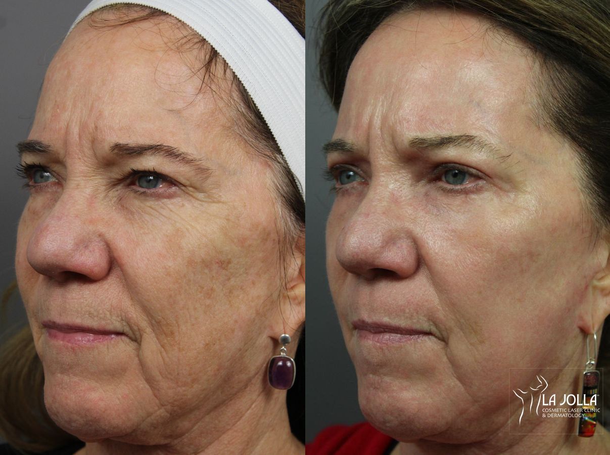Before and after Ablative Laser Treatment case 36304