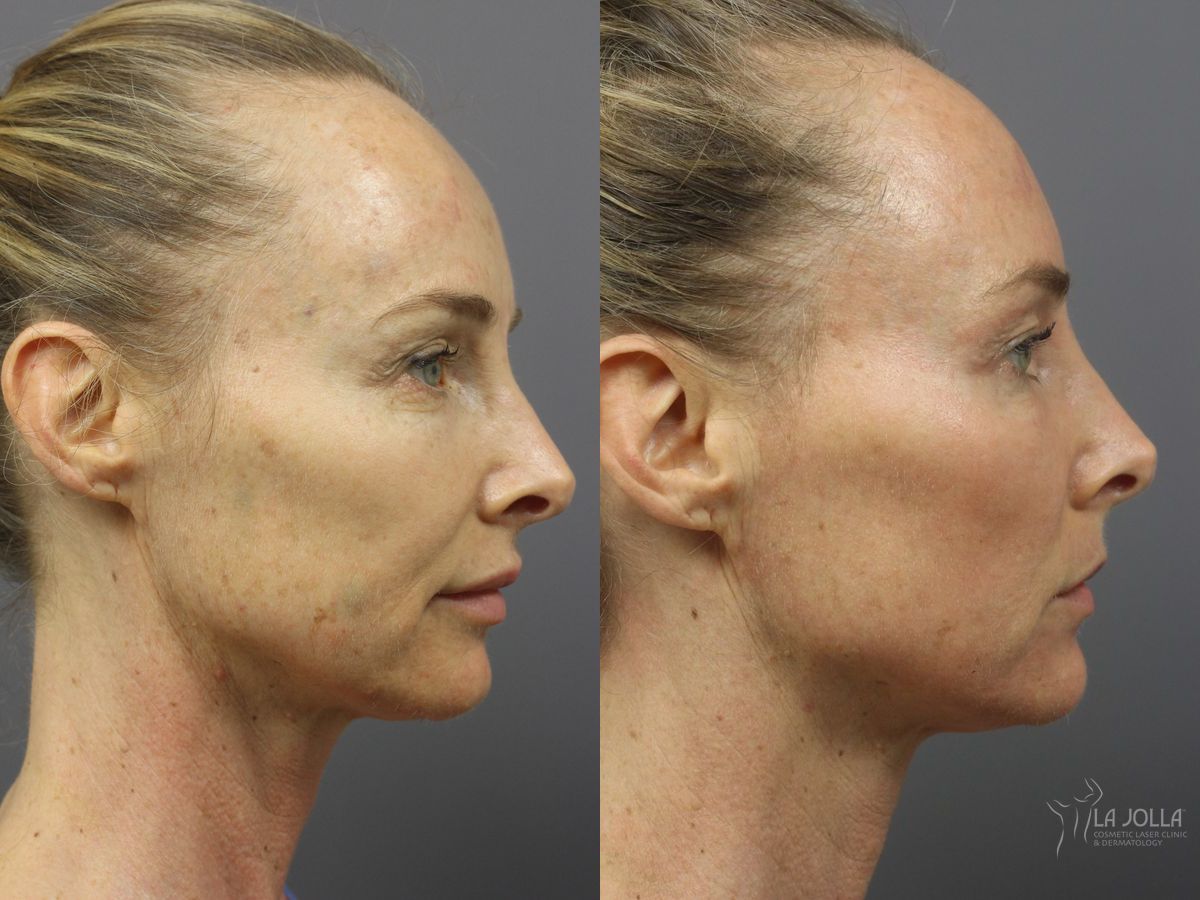 Before and after Ablative Laser Treatment case 36344 - Angle 2