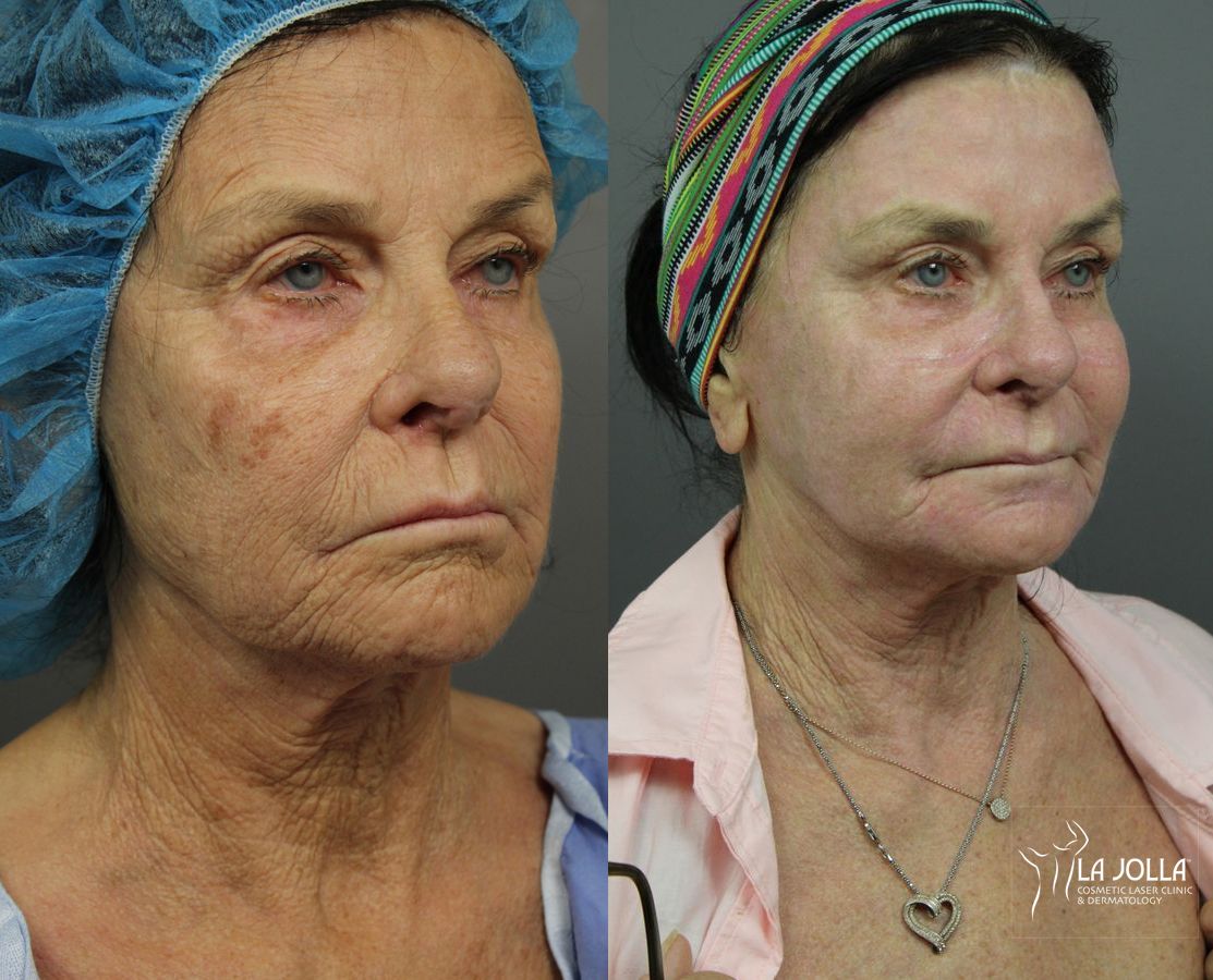 Before and after Ablative Laser Treatment case 36263 - Angle 2