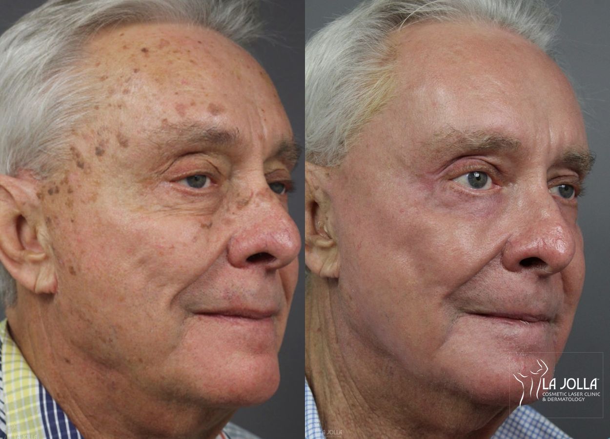 Before and after Ablative Laser Treatment case 36279 - Angle 2
