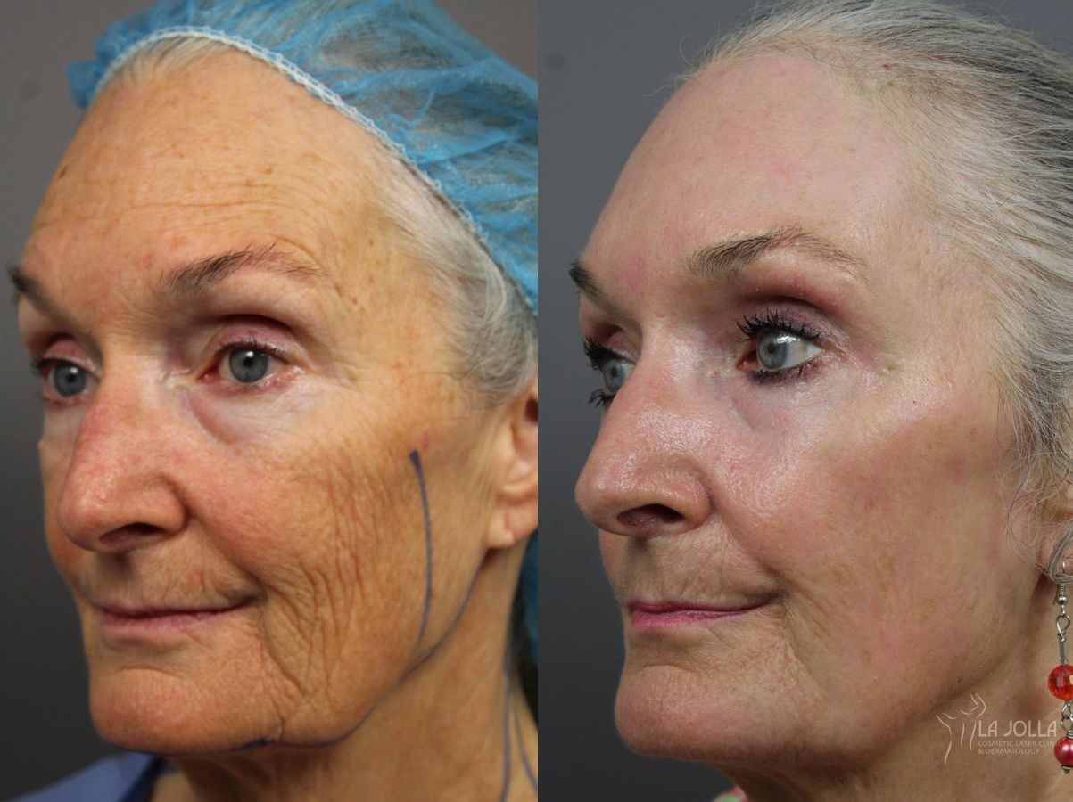 Before and after Ablative Laser Treatment case 36324 - Angle 2
