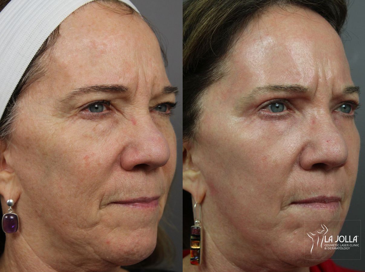 Before and after Ablative Laser Treatment case 36304 - Angle 3