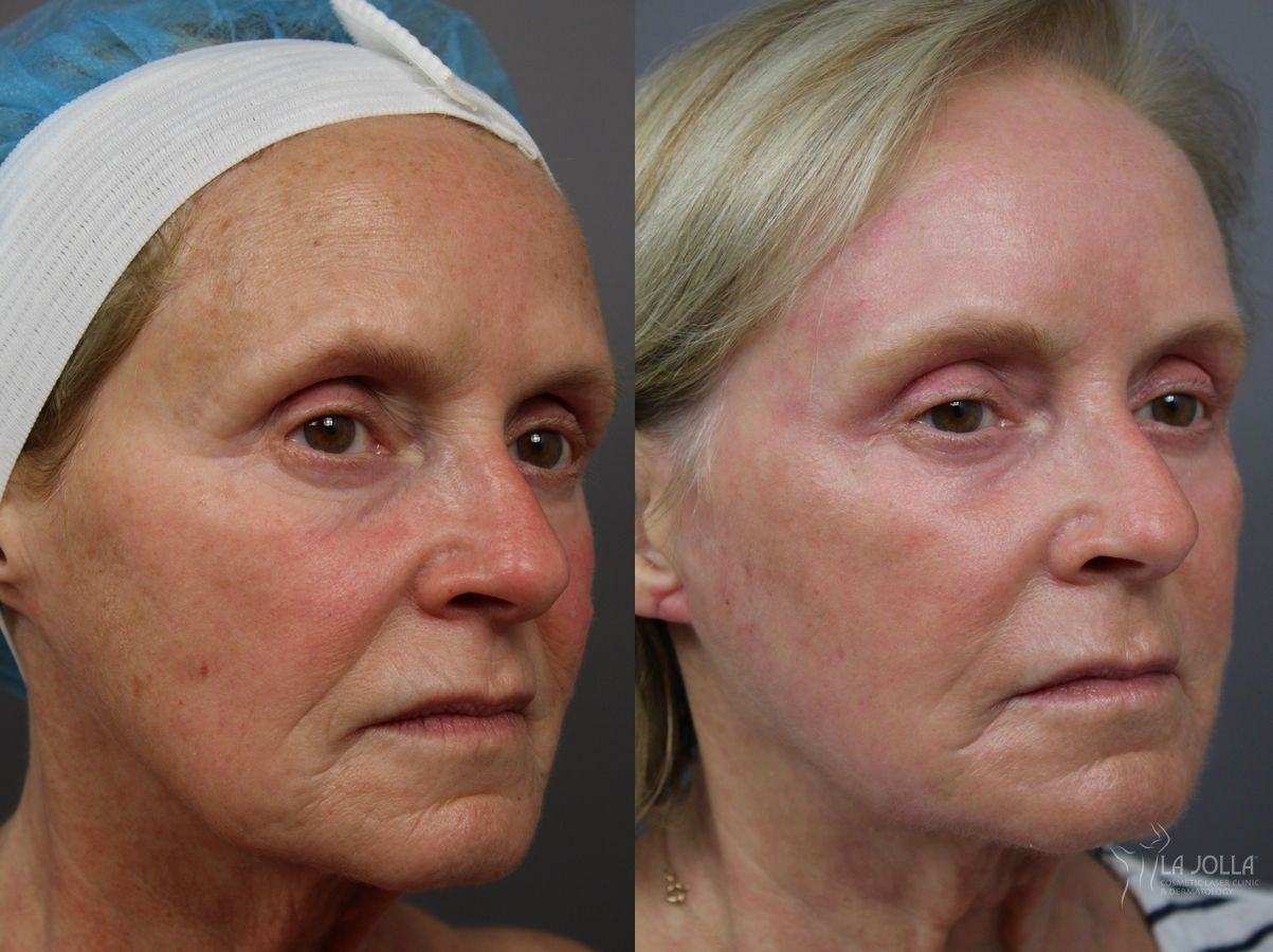 Before and after Ablative Laser Treatment case 36343 - Angle 2
