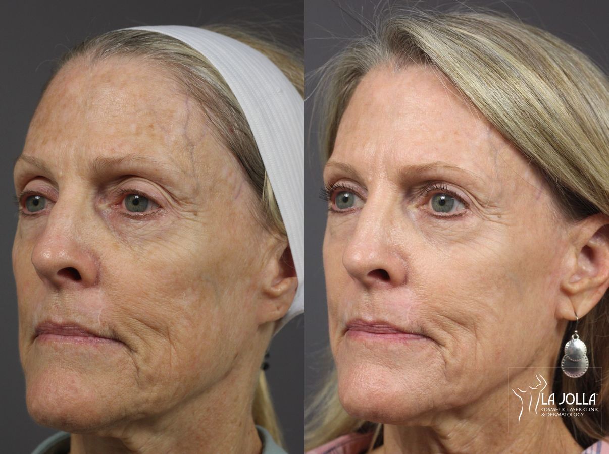 Before and after Ablative Laser Treatment case 36342 - Angle 2