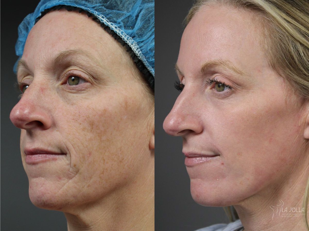 Before and after Ablative Laser Treatment case 41767 - Angle 3