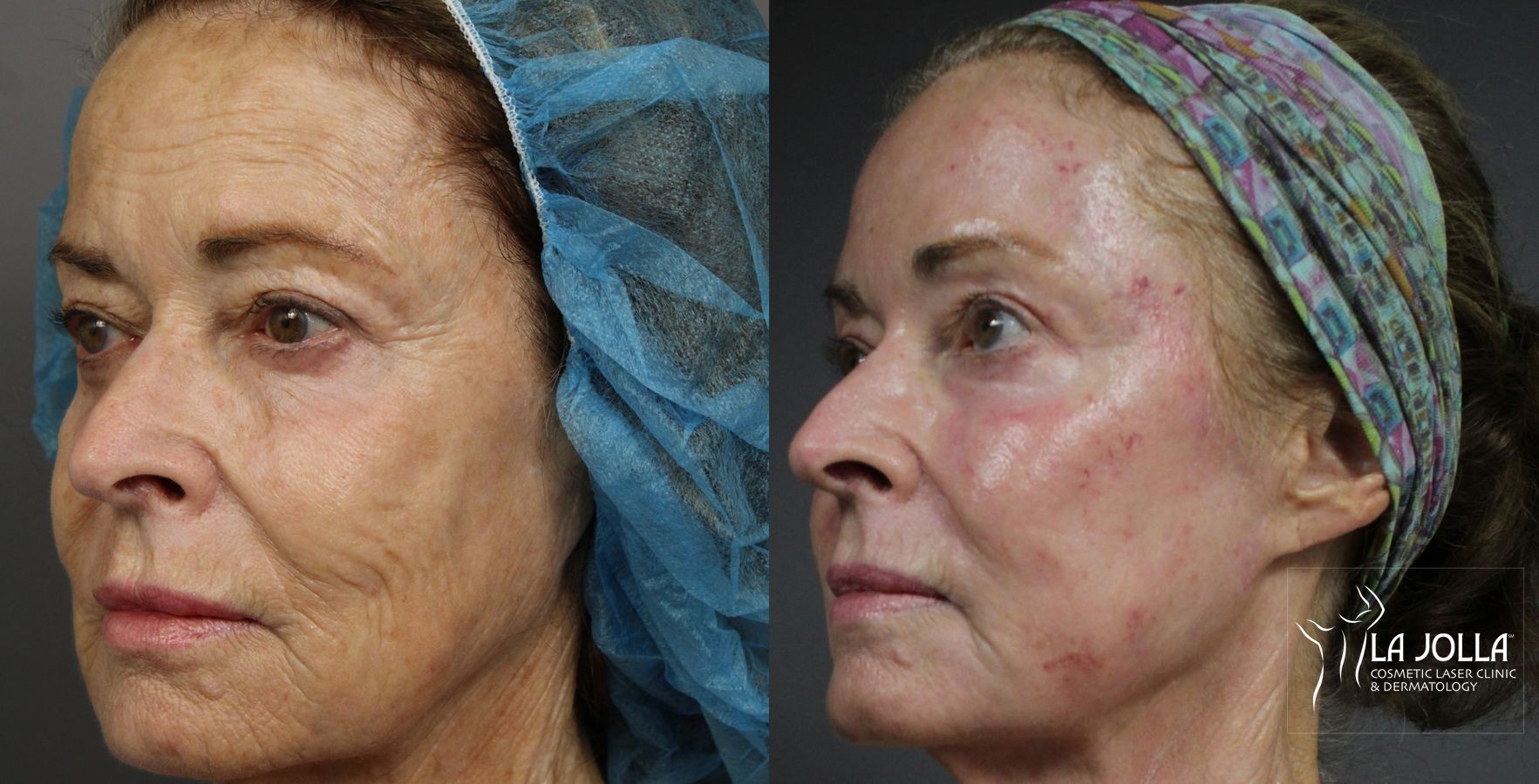 Before and after Ablative Laser Treatment case 36223 - Angle 3