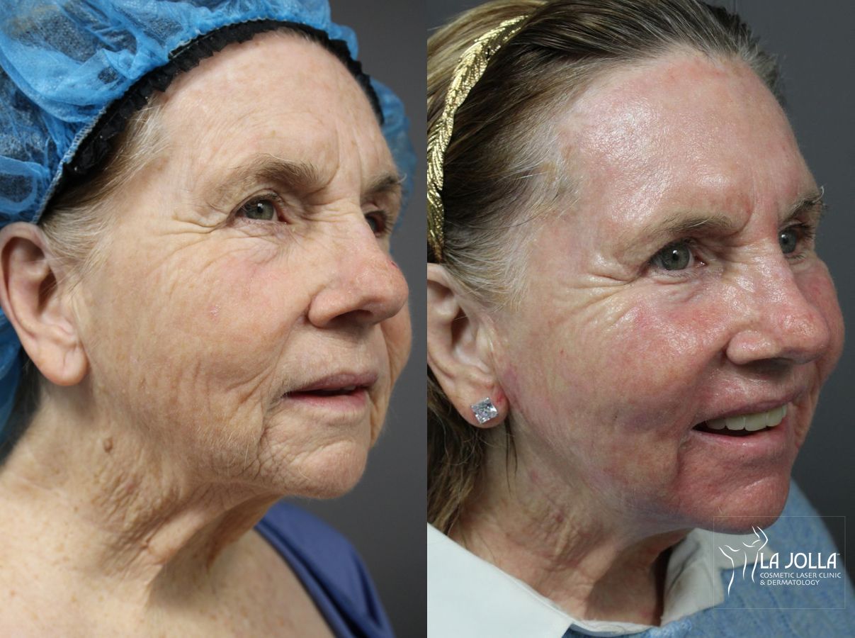 Before and after Ablative Laser Treatment case 36143 - Angle 2