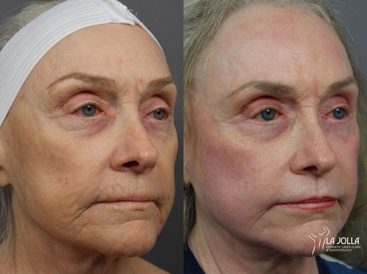 Before and after Ablative Laser Treatment case 36318