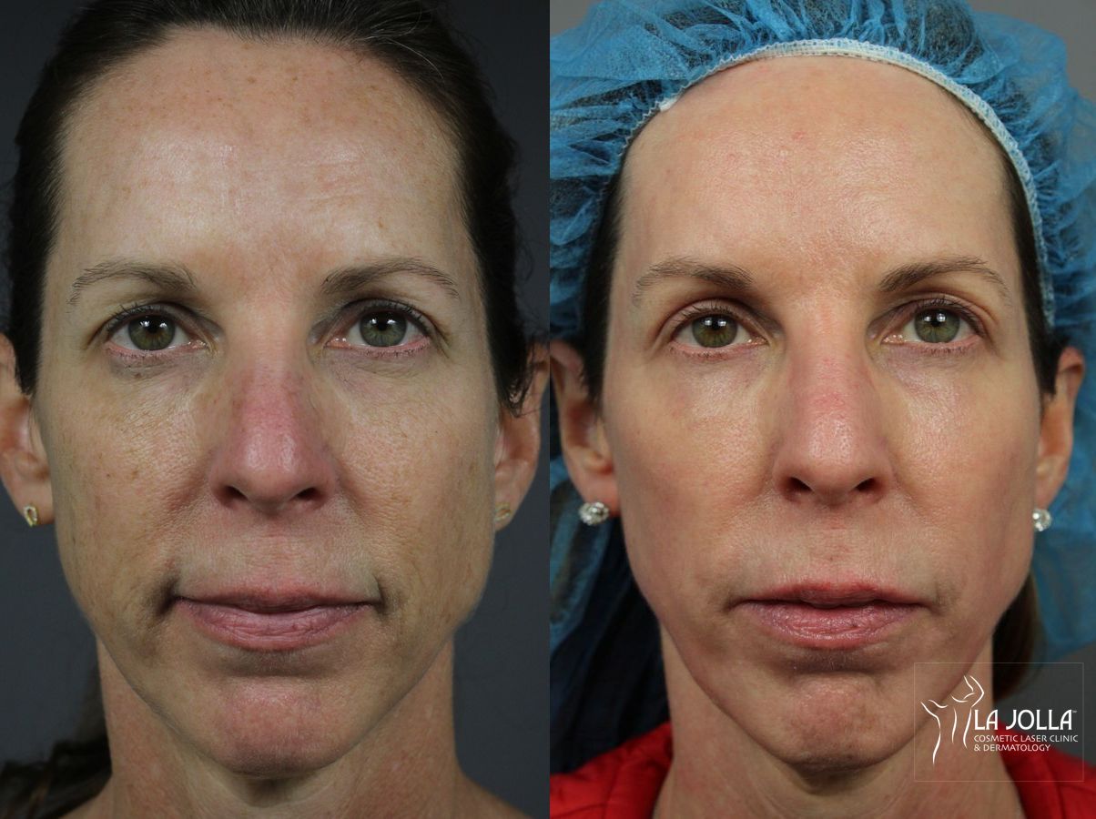 Before and after Ablative Laser Treatment case 36316