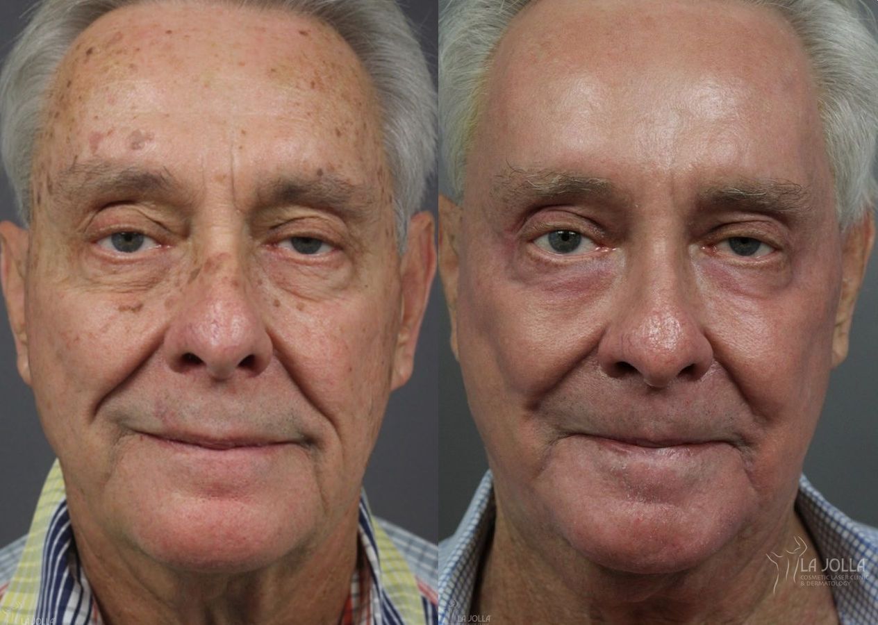 Before and after Ablative Laser Treatment case 36279