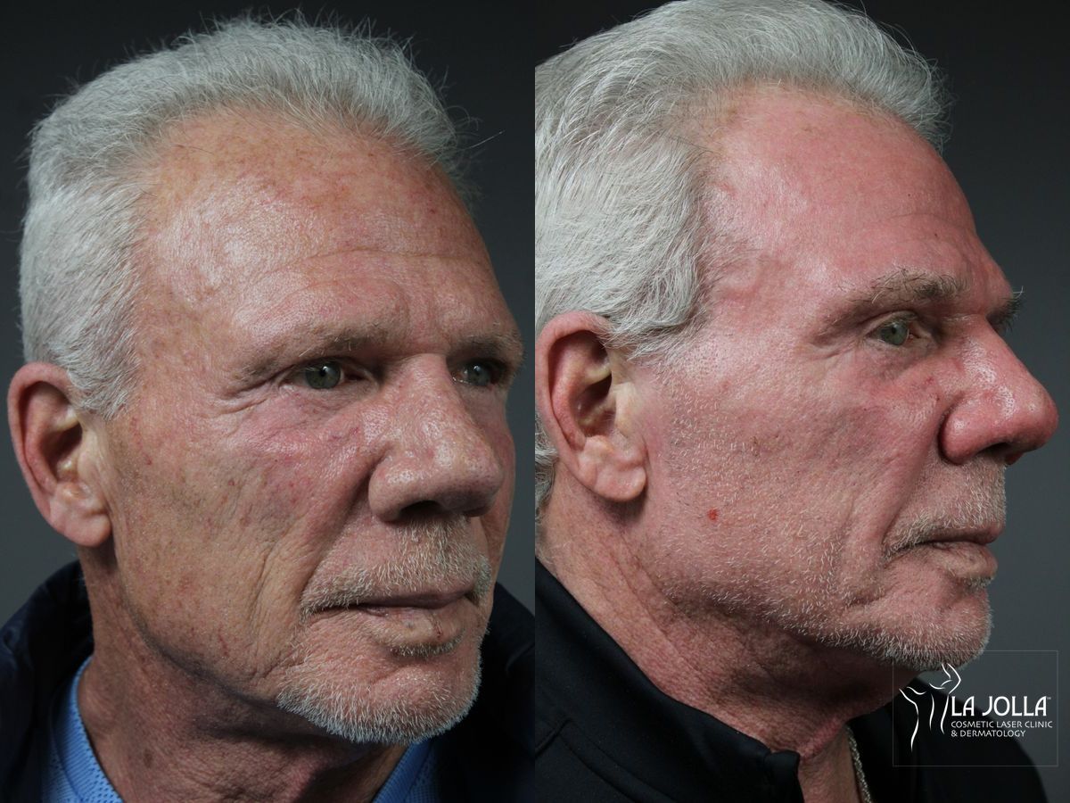 Before and after Ablative Laser Treatment case 36100 - Angle 2