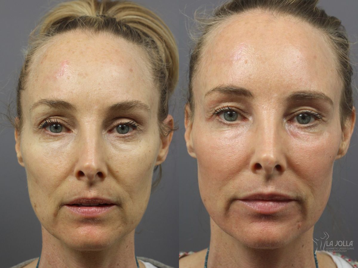 Before and after Ablative Laser Treatment case 36344
