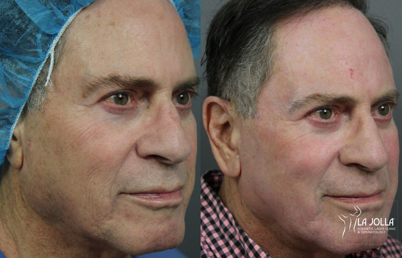 Before and after Ablative Laser Treatment case 36243 - Angle 2