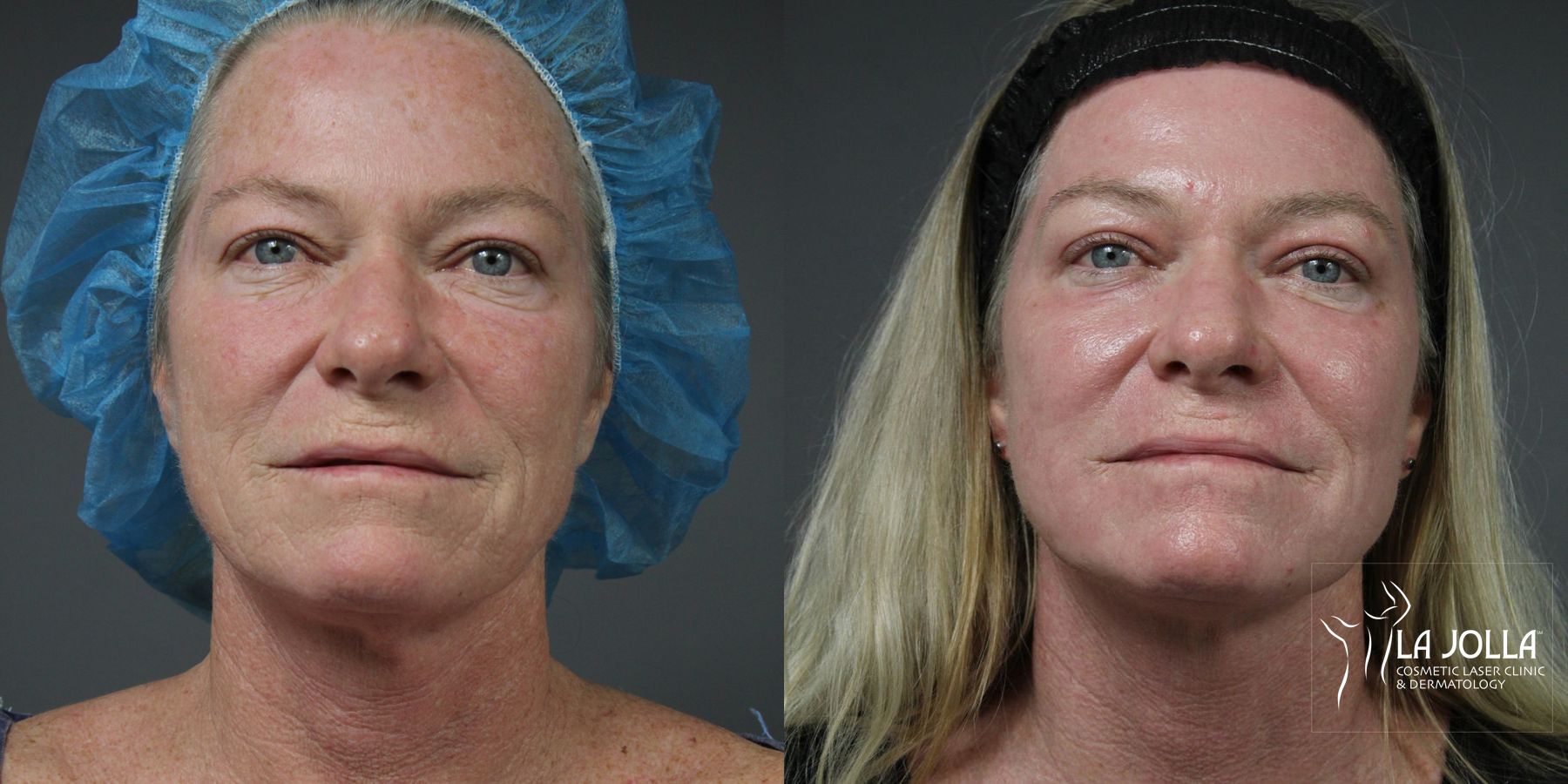 Before and after Ablative Laser Treatment case 36163