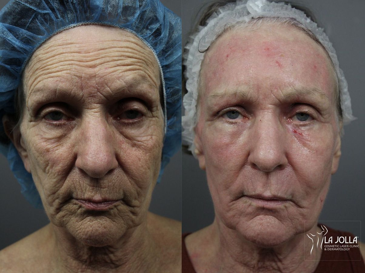 Before and after Ablative Laser Treatment case 36188