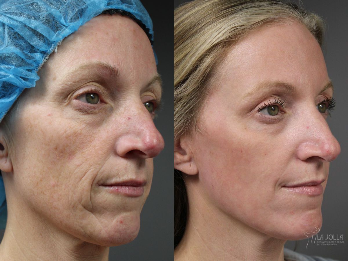 Before and after Ablative Laser Treatment case 41767 - Angle 2