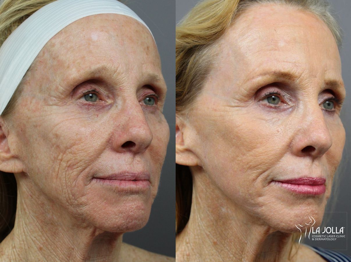 Before and after Ablative Laser Treatment case 36329